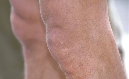 ¿Qué es el líquido de las rodillas y por qué es tan importante?