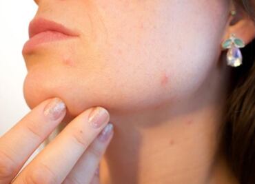 La inflamación "entrena" a la piel para sanar más rápido, según un estudio