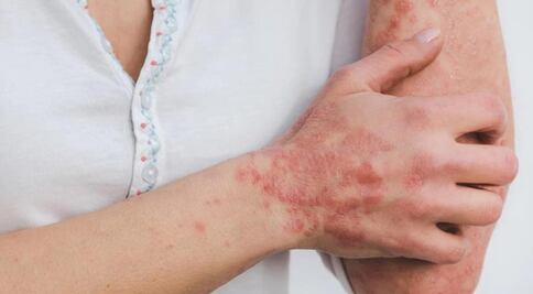 "No hay pruebas" de que la viruela del mono se contraiga por tocar superficies infectadas: estudio 