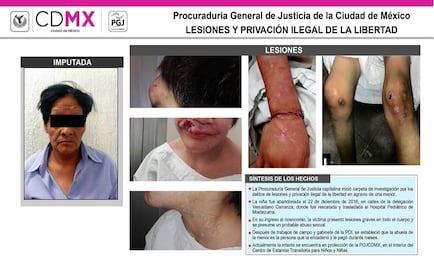 Abuela le causa deformidades y heridas graves a su nieta por maltrato