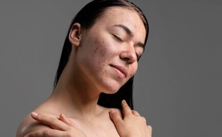 Conoce cómo tratar las cicatrices de acné en tu piel