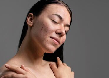 Conoce cómo tratar las cicatrices de acné en tu piel