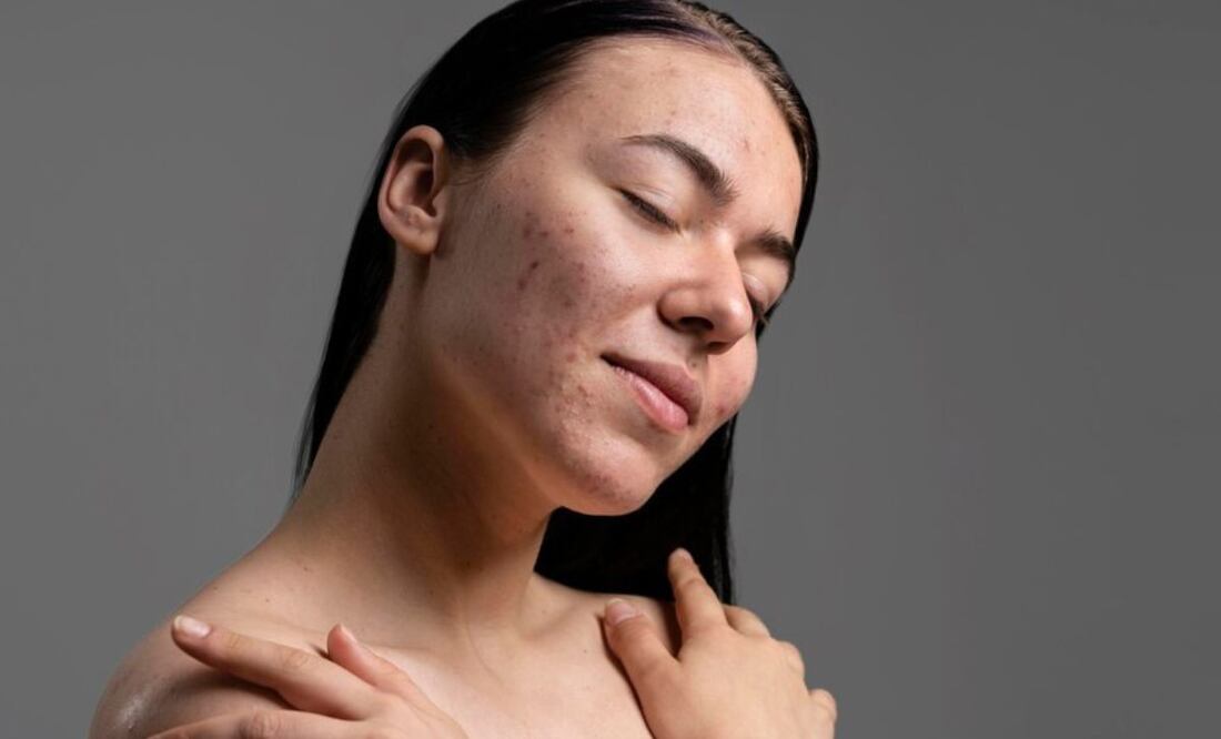 Lo ideal para evitar la aparición del acné es una buena higiene de piel. Fuente: Freepik.