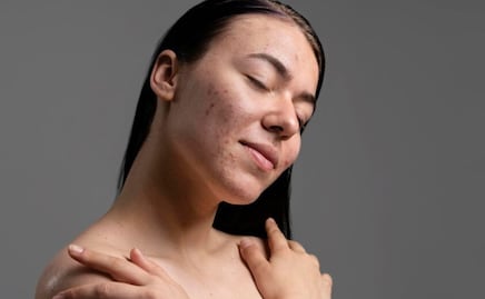 Conoce cómo tratar las cicatrices de acné en tu piel