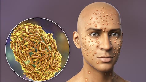 Viruela del mono: lo que hay que saber sobre la declaración de “emergencia de salud global”