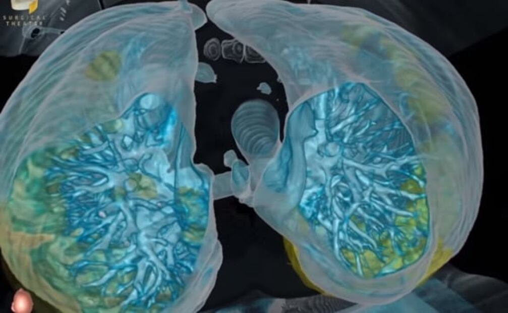 Así se ve el daño del Covid-19 en los pulmones