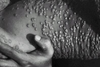 La viruela del mono circulaba mucho antes de ser detectado el primer caso: OMS