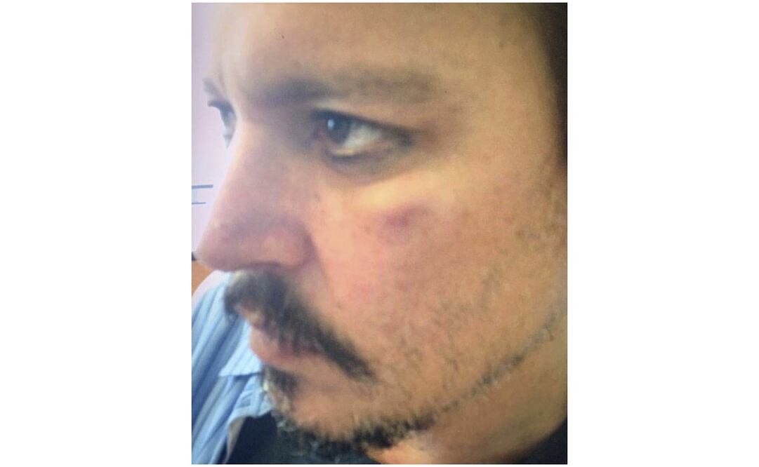 En esta foto proporcionada por el Tribunal Superior de Londres el jueves 16 de julio de 2020, el actor Johnny Depp con lesiones presuntamente sufridas por Amber Heard durante un incidente en Los Ángeles en marzo de 2015