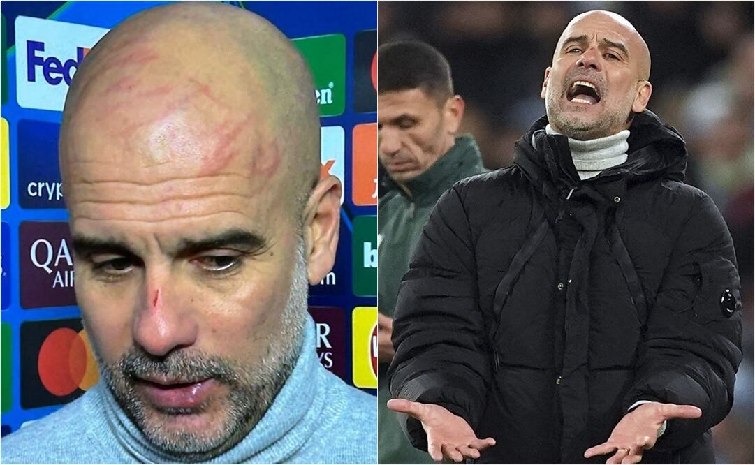 Pep Guardiola apareció ante los medios de comunicación con rasguños en su rostro. FOTO: ESPECIAL