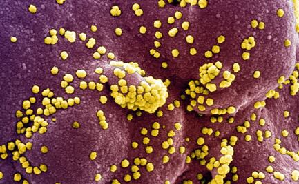 Covid-19: Células inmunes "enloquecidas" ocasionarían inflamación pulmonar