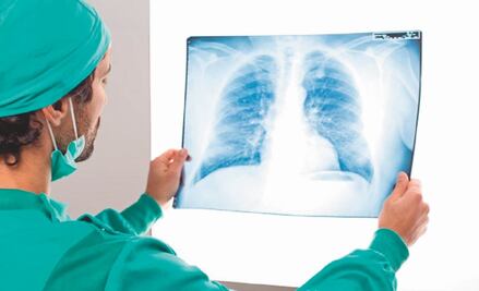 ¿Qué es la fibrosis pulmonar y cuáles son sus síntomas?