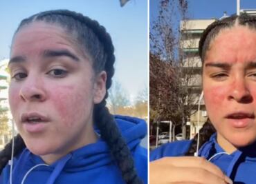 Es alérgica al agua y hasta el sudor le hace daño; aun así, es maestra de natación