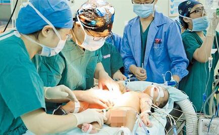 Separan a dos siamesas con el vientre unido en China