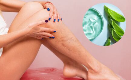 La hierba medicinal que alivia la inflamación de las várices y cuida la salud de las piernas