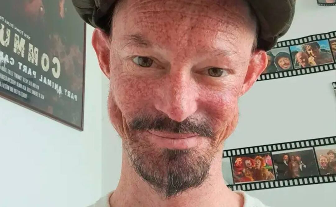 Darren Kent padecía un trastorno en la piel, además de osteoporosis y artritis. Foto: Twitter @CareyDoddAssos