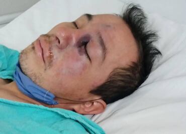 Extirpan a Gregorio tejido por sospecha de "hongo negro"; sigue grave