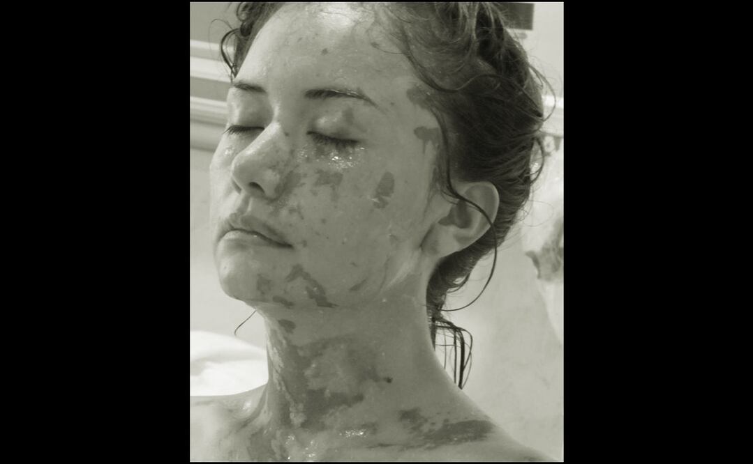 Lesly resultó con heridas en la cara y parte del cuello que tardaron meses en sanar, luego de varias operaciones con injertos y parches. Foto: Especial