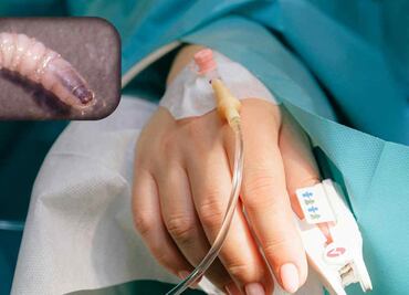 El Salvador reporta 5 casos de personas infectadas con miasis; enfermedad es causada por el gusano barrenador