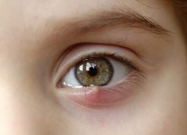 El efectivo tratamiento para curar los orzuelos con una planta común en tu jardín