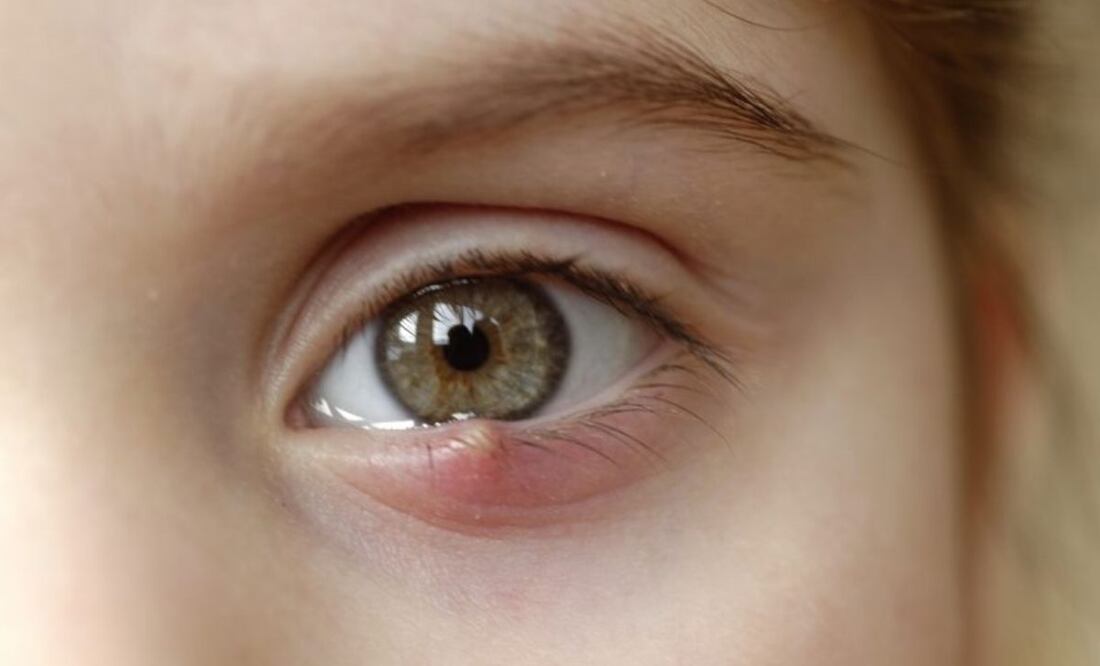 Los orzuelos les pueden salir a cualquier persona. Fuente: Freepik.