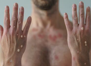 Hong Kong registra su primer caso de viruela del mono