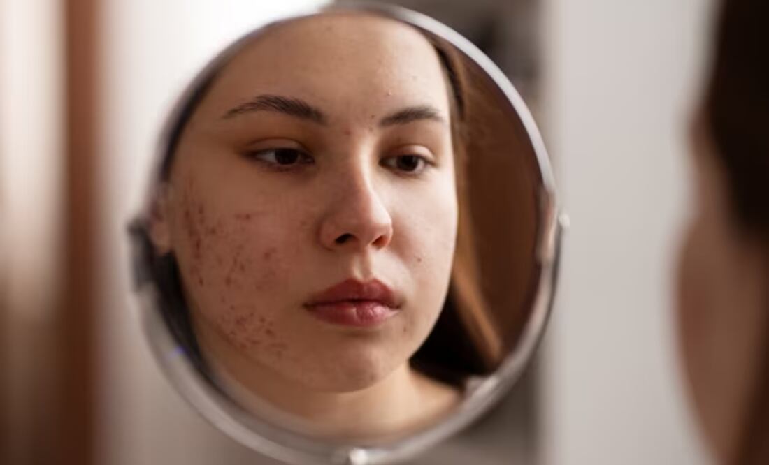 Acné. Fuente: Freepik