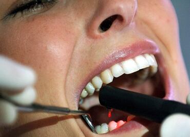 Desarrollan método para detectar microgrietas en dientes