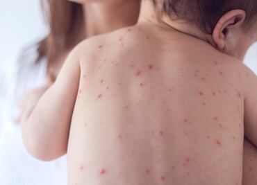 Prevén brote de sarampión en Texas pese a aumento de vacunaciones; advierten “subestimación” en número oficial de casos