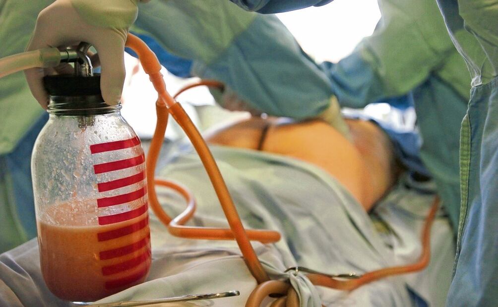 Una cirugía de lipoescultura, que debe realizarse con profesionales que estén debidamente acreditados y certificados. Foto: Miguel Menéndez | EFE