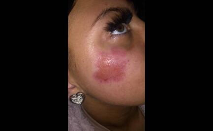 Se incendia cargador de iPhone y le quema el rostro a joven; lo dejó conectado de noche