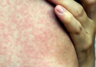 Se aceleran contagios de sarampión en Yucatán; brotes se concentran en cinco municipios