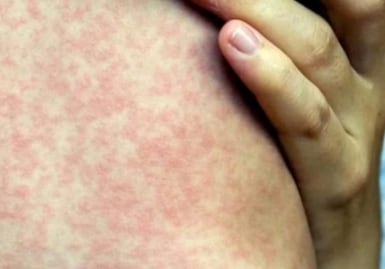 Reportan dos nuevos casos de sarampión en Morelos; van 31 en este año