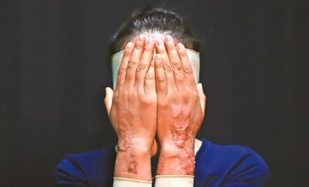 Propone MC en San Lázaro que víctimas de ataque con ácido reciban atención integral en el sector salud