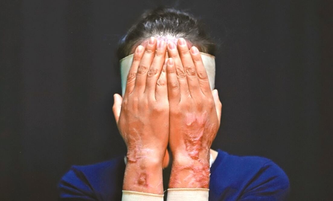 La diputada María Teresa Rosaura impulsa la iniciativa para que se les otorgue hospitalización, cirugías reconstructivas, rehabilitación, servicios de psicología y nutrición. Foto: archivo/EL UNIVERSAL