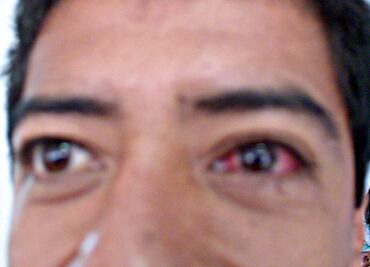 Tabasco registra 192 casos de conjuntivitis hemorrágica