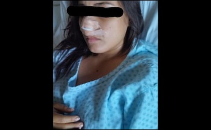 Acusan a excandidato de morder y arrancar parte de la nariz a su esposa en Veracruz