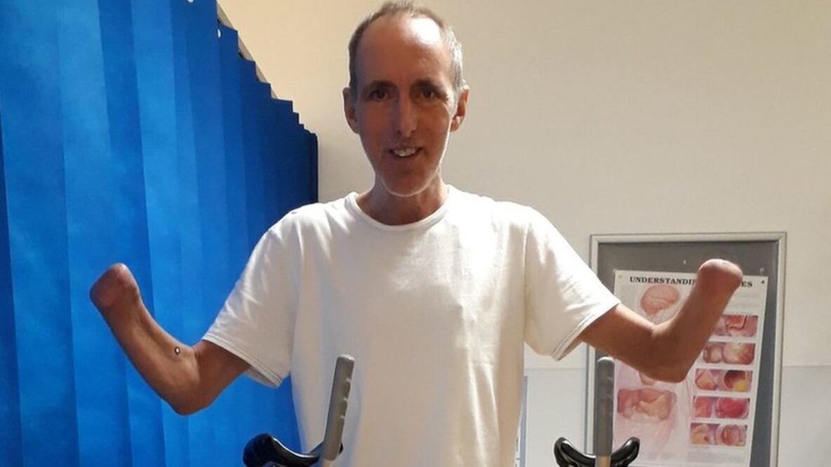 Mike Davies dijo haber aceptado que sus manos y piernas "tenían que desaparecer"