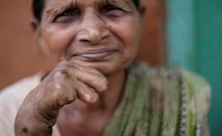 Lepra en México 2020: ¿en qué estados hay casos?