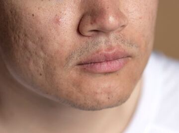 Aprende a combatir el acné en la barbilla