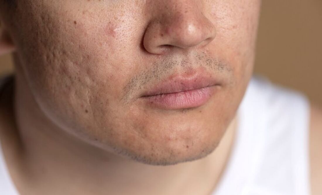 La barbilla es propensa al acné debido a la alta concentración de folículos pilosebáceos. Fuente: Freepik.