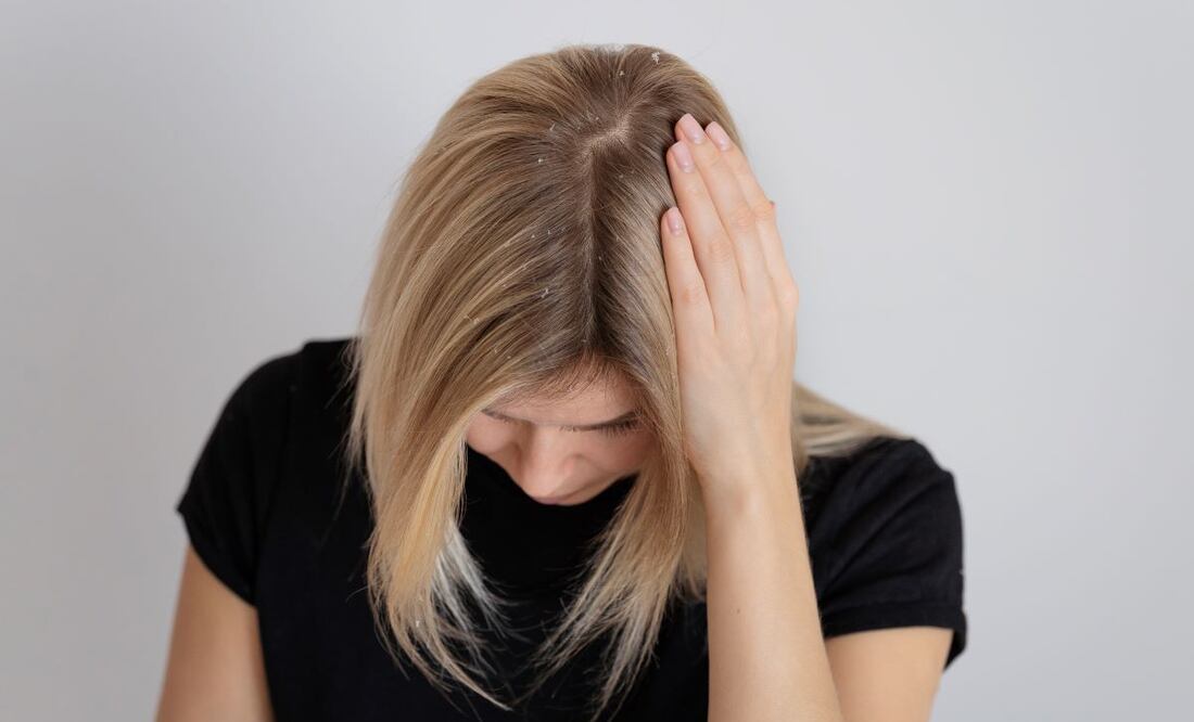 Estos hábitos empeoran la caspa. Foto: Freepik