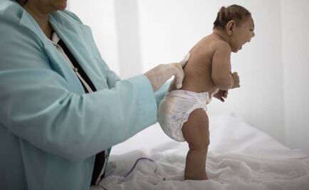 Confirman relación entre zika y defectos de nacimiento