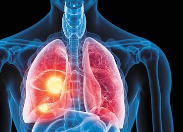 Los pulmones también albergan anticuerpos contra el Covid-19