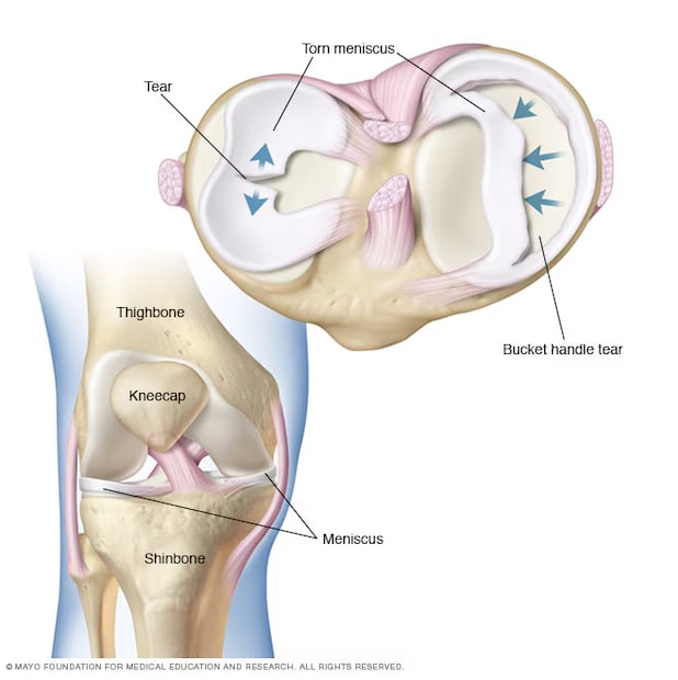 Imagen de una rotura de menisco. Foto: Mayo Clinic