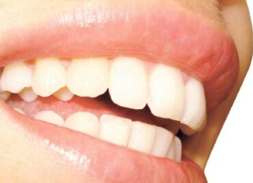 Desarrollan dientes en 3D que pueden combatir la placa bacteriana