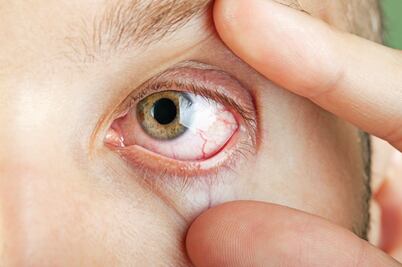 Cada vez más casos del síndrome de ojo seco