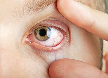 Cada vez más casos del síndrome de ojo seco