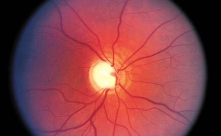 Siete de 10 personas desconocen tener glaucoma