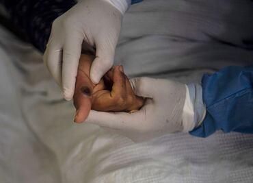 Fallece primer caso de viruela del mono detectado en Cuba