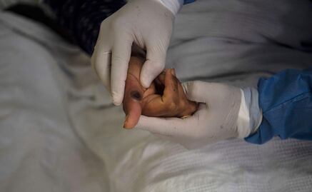 Fallece primer caso de viruela del mono detectado en Cuba